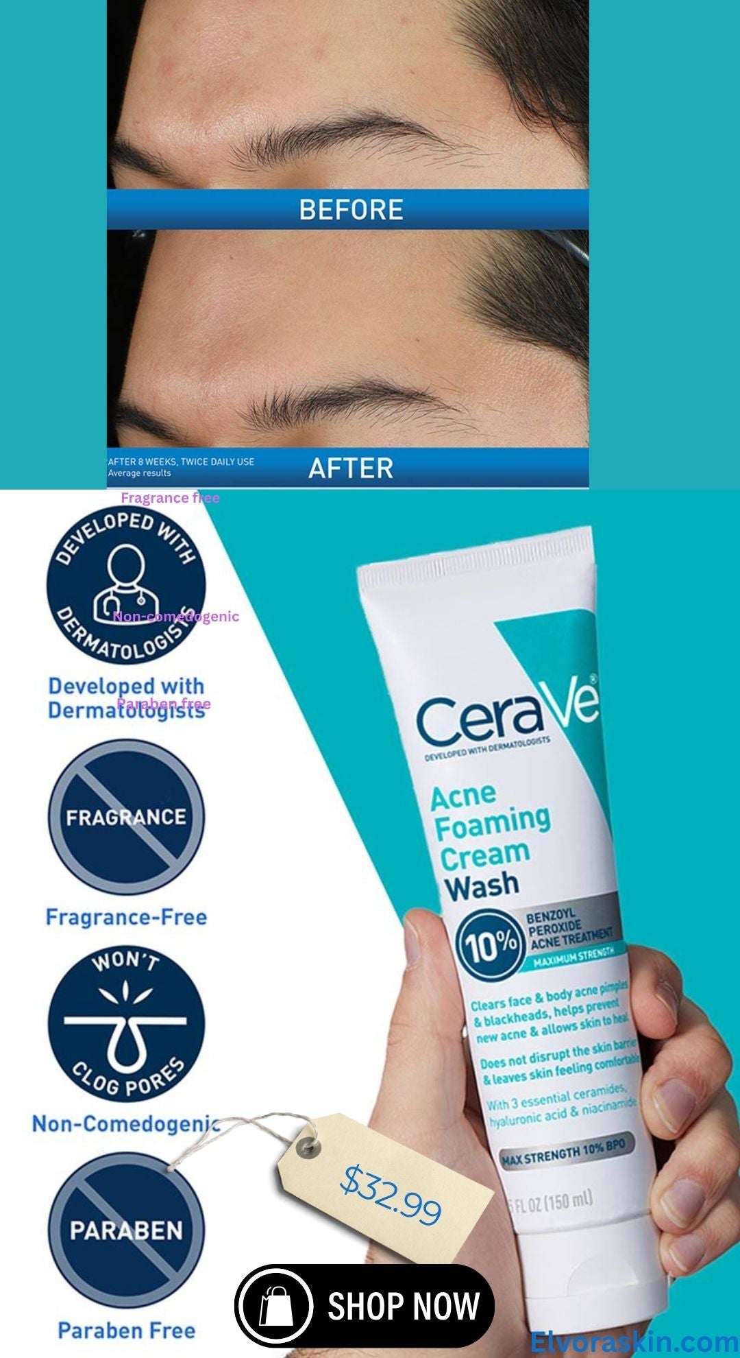 CeraVe Acne Foaming Cream Wash Gentle Face and Body Cleanser with Benzoyl Peroxide 10% Hyaluronic Acid and Niacinamide 10% Benzoyl Peroxide Treatment Clears Pimples and Blackheads 5 Oz